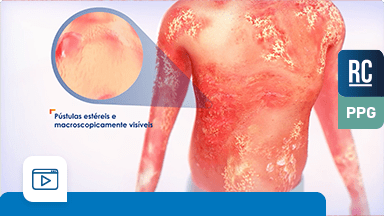 O papel da IL-36 na fisiopatologia da PPG