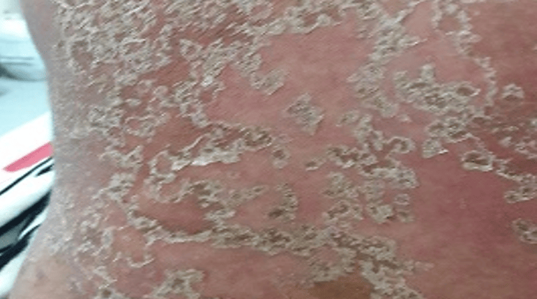 Manifestação cutânea das crises de PPG