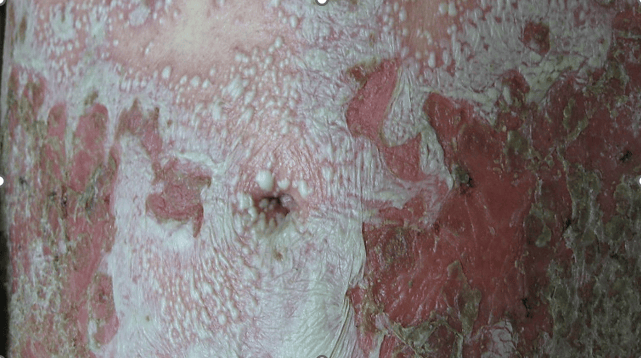 Manifestação cutânea das crises de PPG